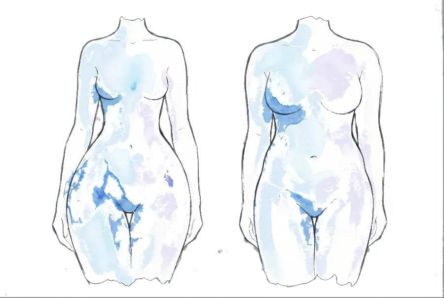 Ilustração comparando a silhueta do lipedema com a da obesidade